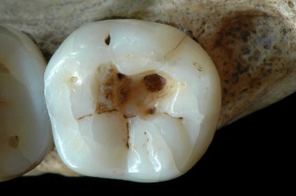 Những chiếc răng đau của người cổ đại