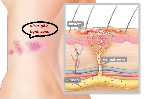 Virus gây bệnh zona thường trú ngụ tại vị trí có nhiều dây thần kinh