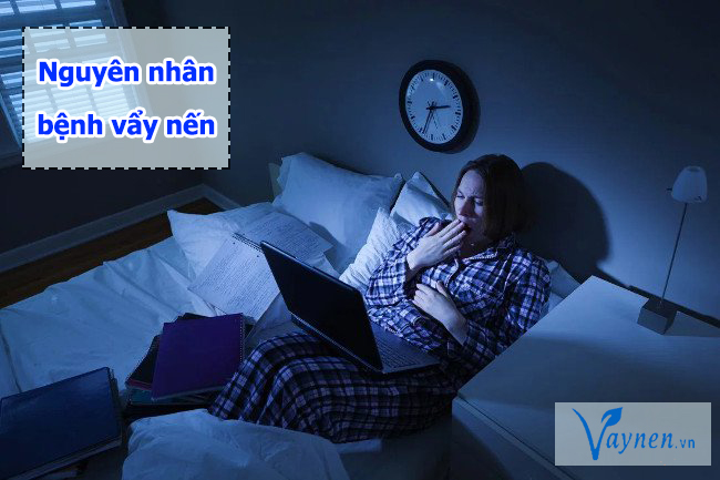 Ngủ muộn gây suy yếu hệ miễn dịch, có thể làm bùng phát bệnh vẩy nến