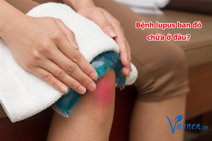 Người bị lupus ban đỏ thường bị đau khớp