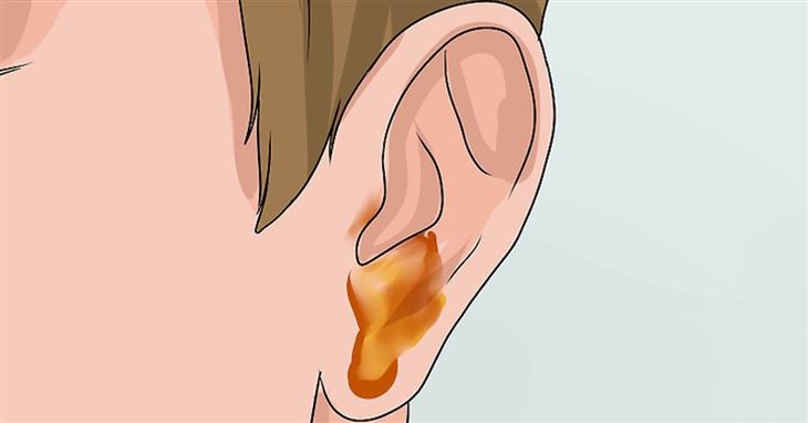 Viêm tai giữa gây ù tai