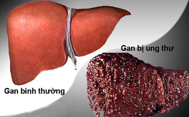 Gan nhiễm mỡ có thể dẫn đến ung thư gan nếu không được điều trị sớm
