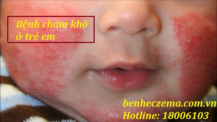 Bệnh chàm khô ở trẻ em dưới 6 tháng tuổi đặc trưng bởi các nốt hồng ban có mụn nước