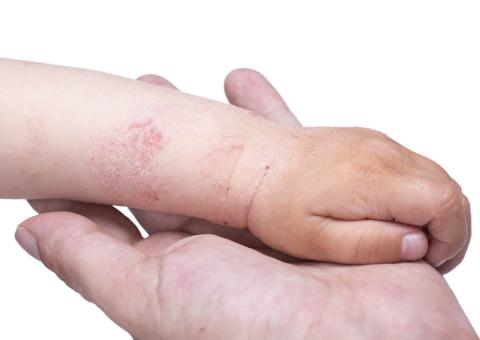 Bệnh chàm khô ở trẻ em từ 6 – 12 tháng tuổi là những lớp vảy vàng, phồng rộp