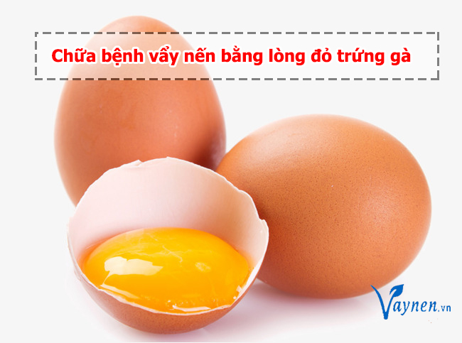 Lòng đỏ trứng gà giúp cải thiện tình trạng vẩy nến