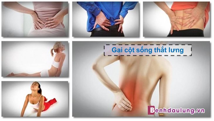 Gai cột sống thắt lưng