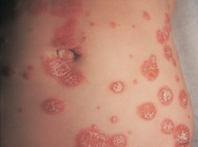 Bệnh chàm biểu hiện bởi những mảng da có vẩy và có thể có mụn nước