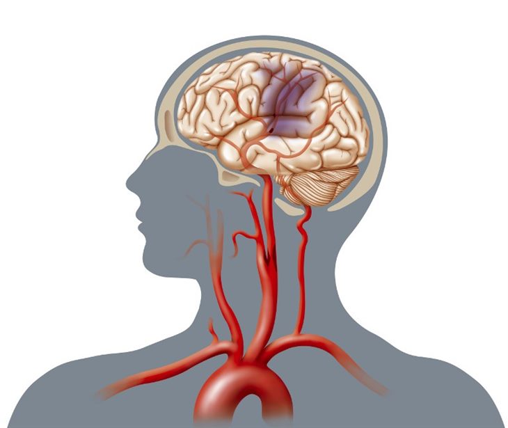 Nhồi máu não rất phổ biến ở bệnh nhân đột quỵ