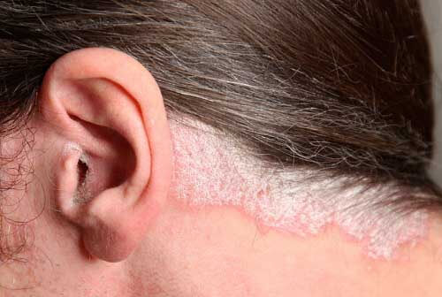 Vảy nến thường xuất hiện ở da đầu