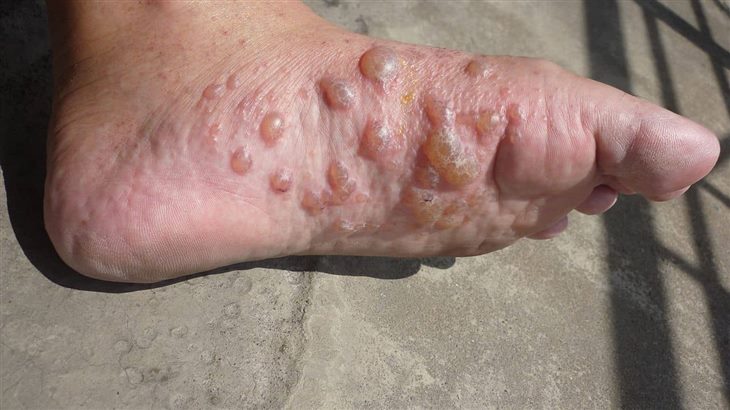 Bệnh chàm tổ đỉa lòng bàn chân đặc trưng bởi các mụn nước