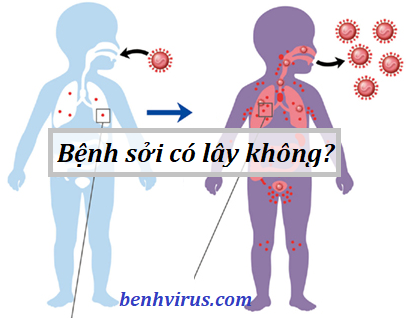 Virus sởi dễ lây lan và phát triển thành đại dịch