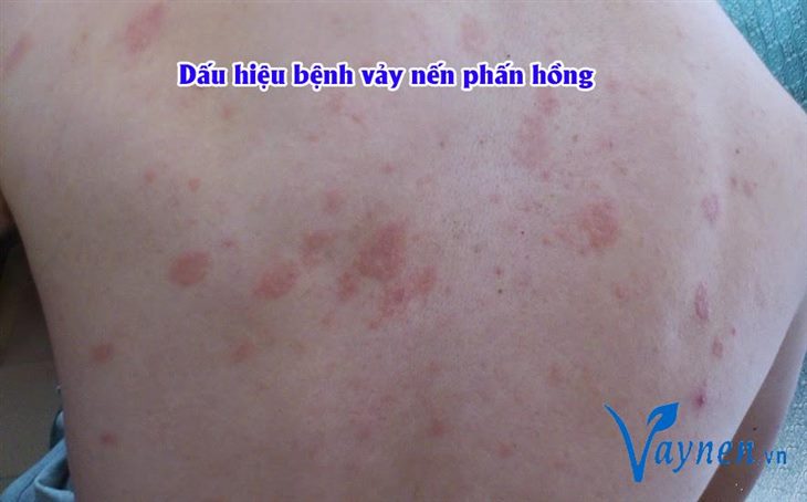 Dấu hiệu bệnh vảy nến phấn hồng