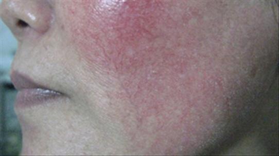 Thuốc điều trị vẩy nến toàn thân có thể gây teo da