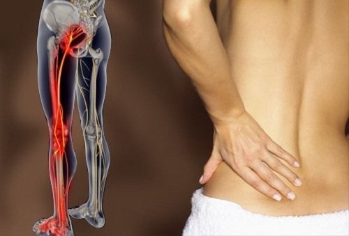 Đau rễ thần kinh gây đau thắt lưng lan xuống mông và chân