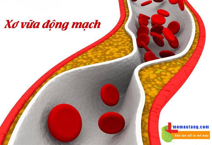 Xơ vữa động mạch là biến chứng phổ biến của máu nhiễm mỡ