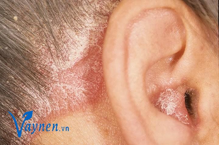 Triệu chứng bệnh vảy nến ở tai