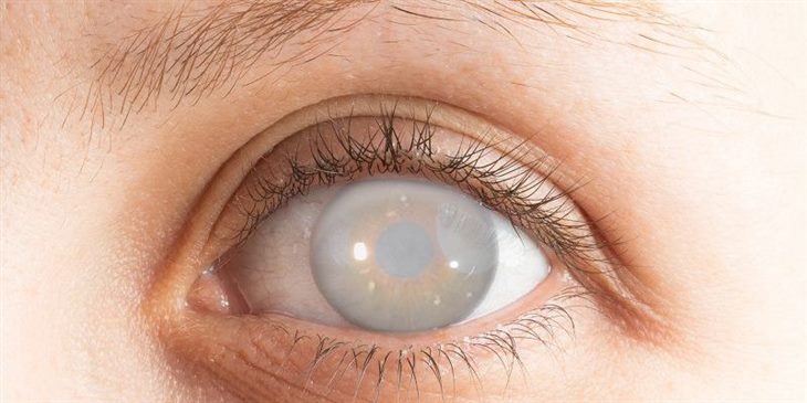 Viêm da dị ứng có thể gây biến chứng ở mắt