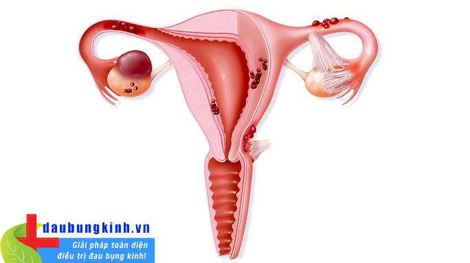 Lạc nội mạc tử cung là lý do đau bụng kinh rất phổ biến