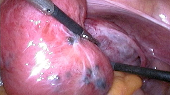 Lạc nội mạc trong cơ tử cung khiến tử cung như một khối cơ bầm tím