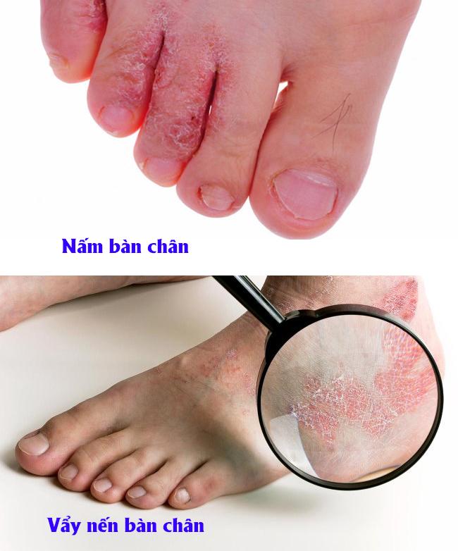 Nấm và vẩy nến bàn chân có nhiều điểm tương đồng cần phân biệt chính xác