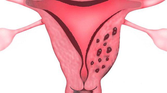 Lạc nội mạc tử cung có thể làm biến dạng hoặc phong tỏa cơ quan sinh sản