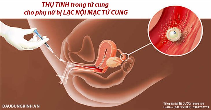 Thụ tinh trong tử cung là một phương pháp điều trị vô sinh do lạc nội mạc tử cung