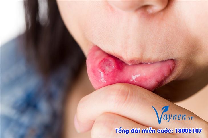 Lupus ban đỏ có thể gây loét miệng