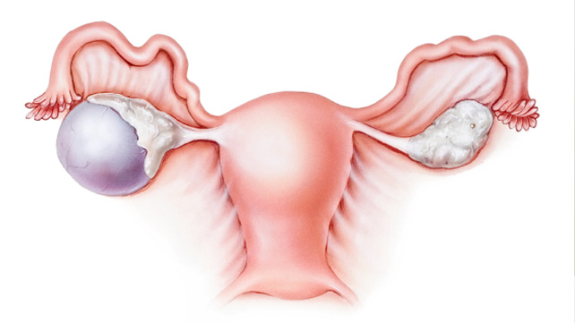 Lạc nội mạc tử cung có thể liên quan đến sự xuất hiện của các khối u ác tính