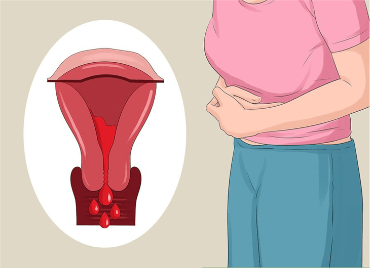 Lạc nội mạc tử cung là một trong những nguyên nhân gây rối loạn kinh nguyệt