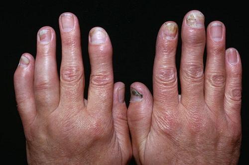 Ngón tay bị sưng trong bệnh viêm khớp vảy nến