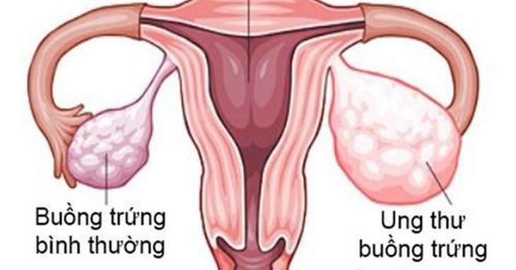 Phụ nữ mắc lạc nội mạc tử cung có nguy cơ bị ung thư buồng trứng