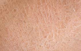 Da khô sẽ khiến bệnh eczema tái phát