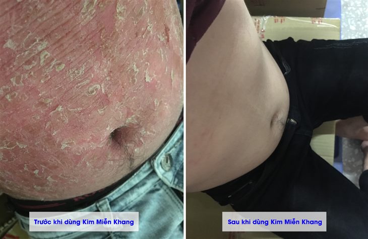 Làn da bụng của anh Trung trước và sau khi dùng Kim Miễn Khang