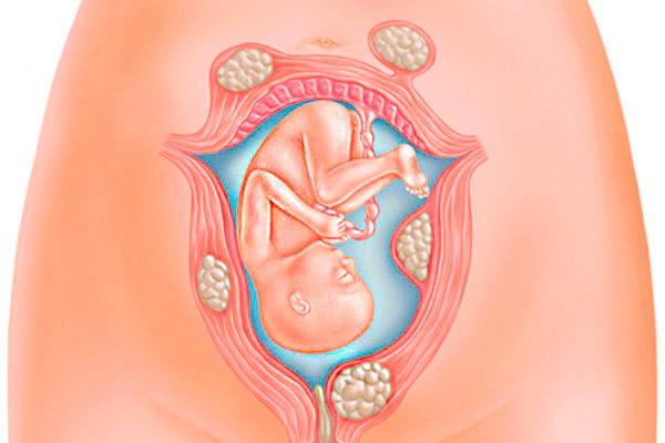 U xơ tử cung có thể đe dọa tính mạng thai nhi