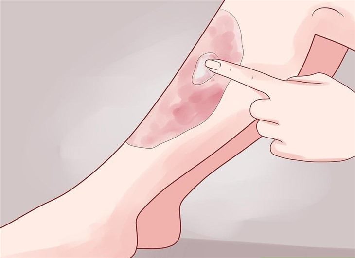 Các loại thuốc bôi ngoài da giúp cải thiện triệu chứng vẩy nến ở chân