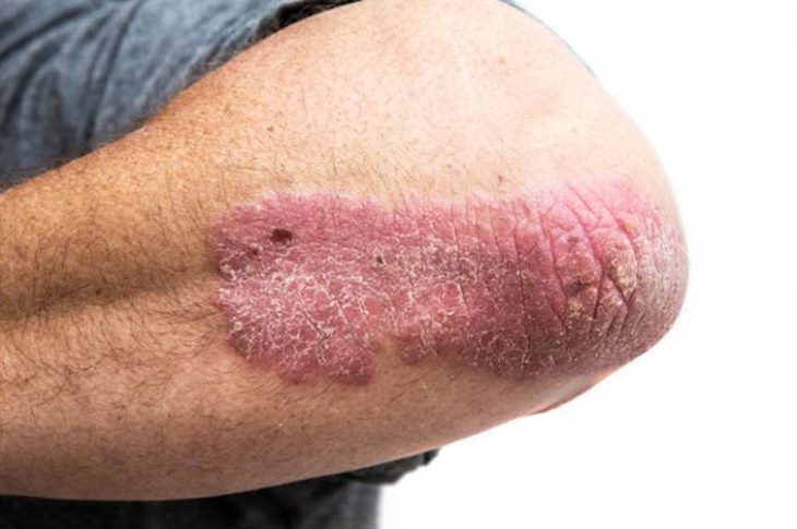 Các tổn thương da của bệnh chàm thường gây ngứa, đỏ và tróc vảy