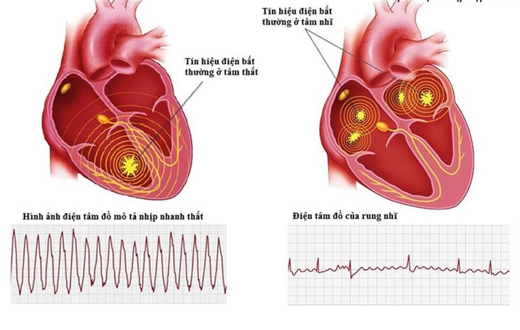 Tăng huyết áp có thể gây rối loạn nhịp tim