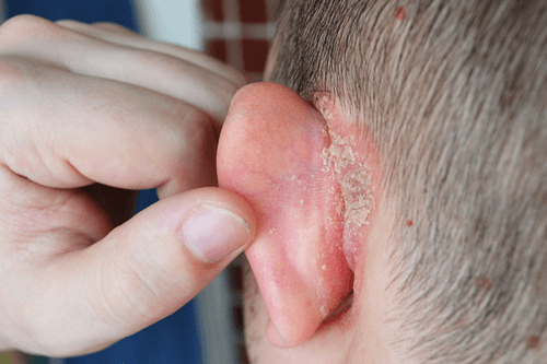 Triệu chứng vảy nến da đầu có thể lan ra sau tai