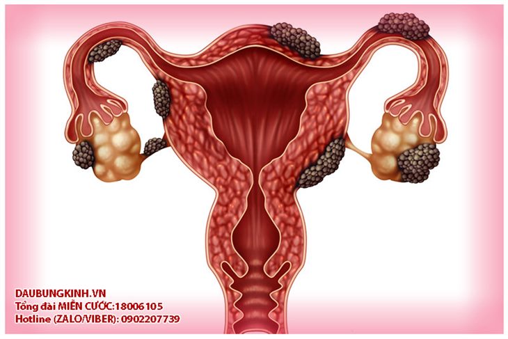 Các mô nội mạc tử cung phát triển sai vị trí gọi là lạc nội mạc tử cung