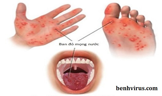 Bệnh tay chân miệng rất dễ bùng phát thành đại dịch