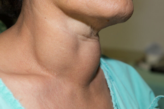 Người mắc bệnh bướu tuyến giáp thường thấy cổ mình bị đầy lên (ảnh minh họa)