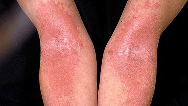 Viêm da dị ứng là dạng phổ biến nhất của bệnh eczema