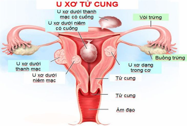 U xơ tử cung có thể gây đau bụng kinh dữ dội