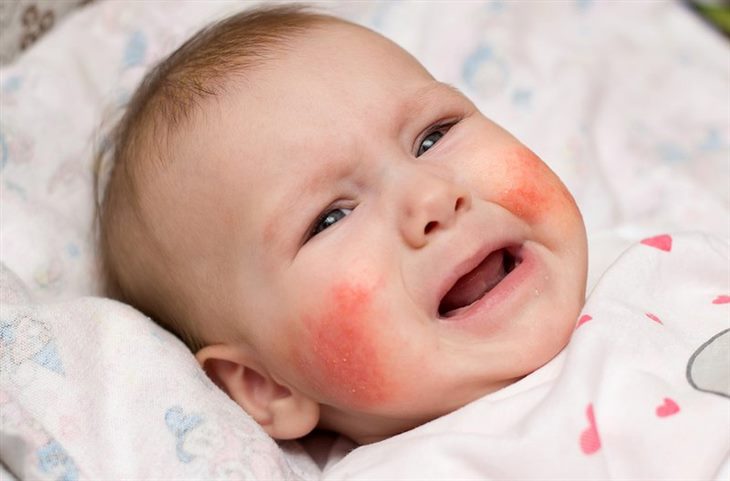 Bệnh chàm có thể gây đau đớn, ngứa ngáy và đỏ rát cho trẻ