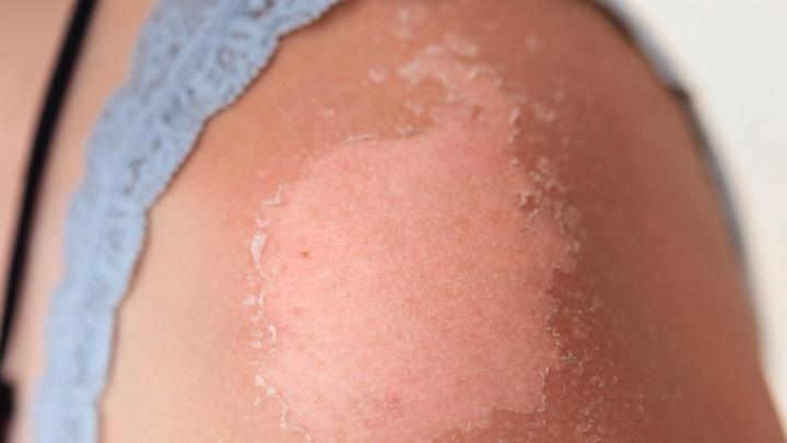 Da bị cháy nắng có thể kích hoạt bùng phát lupus ban đỏ