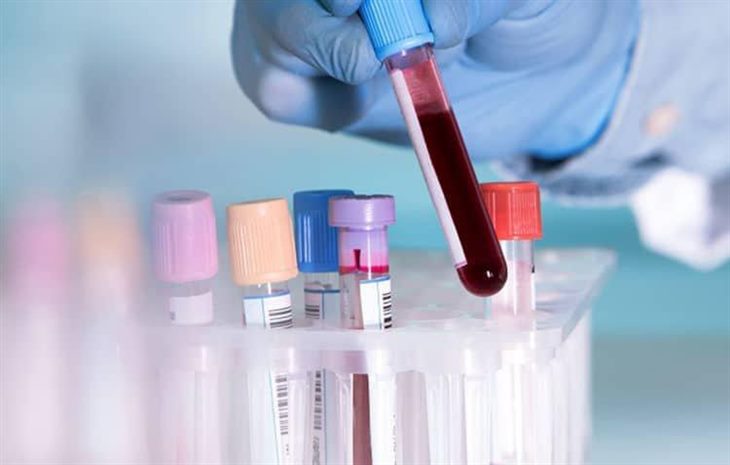 Xét nghiệm máu giúp chẩn đoán lupus ban đỏ