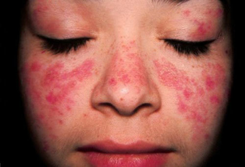 Dấu hiệu bệnh lupus ban đỏ