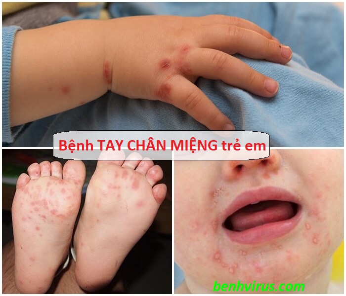 Trẻ bị tay chân miệng cần được chữa trị sớm để không gặp nguy hiểm