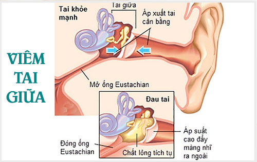 Viêm tai giữa – Biến chứng nguy hiểm của bệnh thủy đậu