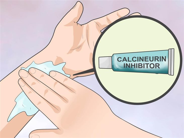 Thuốc ức chế calcineurin giúp giảm viêm trong bệnh viêm da cơ địa dị ứng